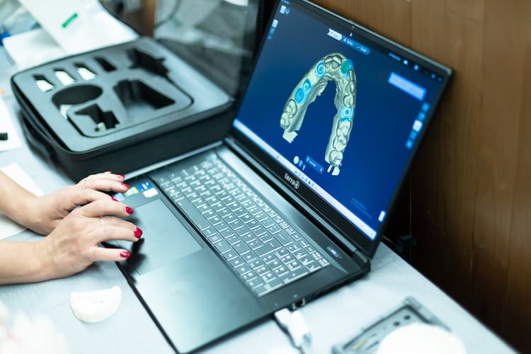 single unit implant restorations event technology Implant restoration software on a laptop
